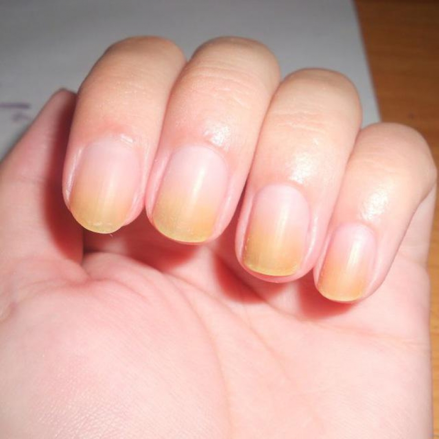 10 بیماری ناشناخته ناخن را بشناسیم