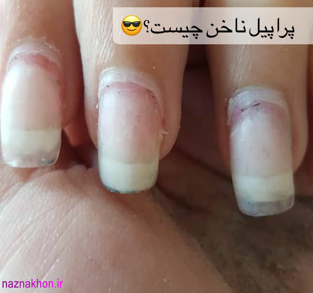 (پروپیل ) اشتباه فاجعه بار در کاشت ناخن